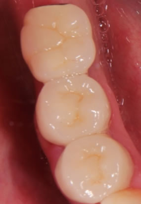 Ceramic teeth after example 2