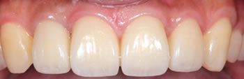 Ceramic teeth after example 1