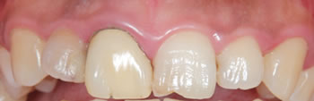Ceramic teeth before example 1