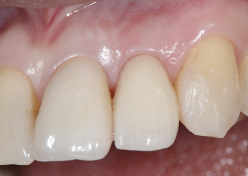 Dental implant for front tooth after