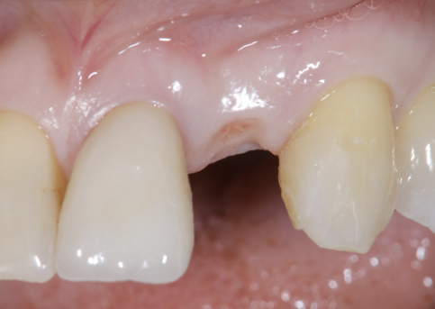 Dental implant for front tooth before