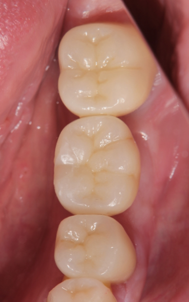 Dental implant for single molar tooth after