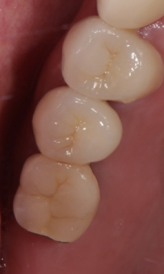 Dental implant for upper rear molars after