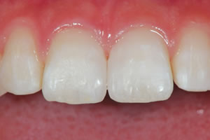 Gap teeth direct bonding example 2 after