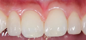 Gap teeth direct bonding example 3 after