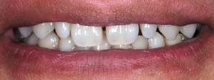 Gap teeth direct bonding example 3a before