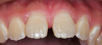 Using Invisalign to close a gap in the front teeth before