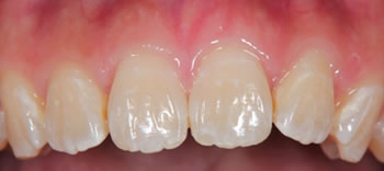 Using an aligner to close a gap in the front teeth after