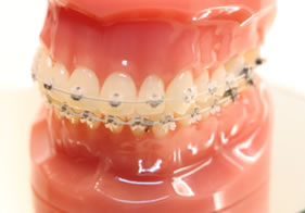 Wire braces orthodontics