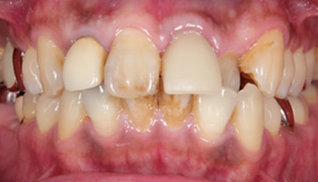 ガタガタ歯並びを矯正治療で綺麗にした症例　術前