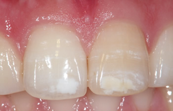 歯を削って白濁を消す方法　術前