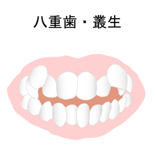 八重歯（ガタガタ歯並び）