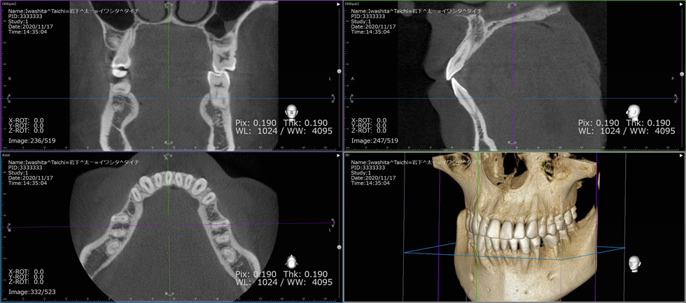 CT画像による骨診断