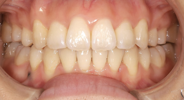 八重歯の治療例　Aftre