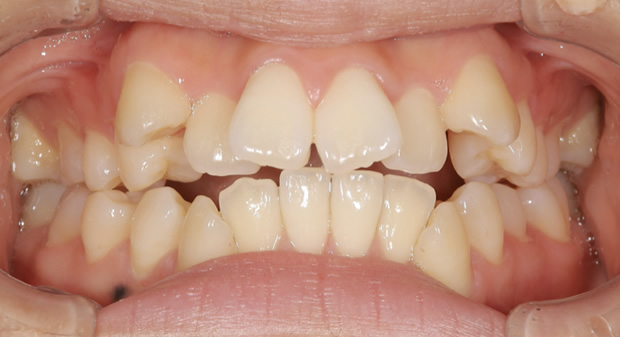 八重歯の治療例　Before