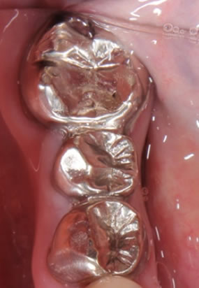 Ceramic teeth before example 3