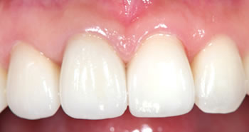 Ceramic teeth after example 3