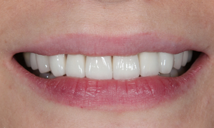 Esthetic dentistry after example 1