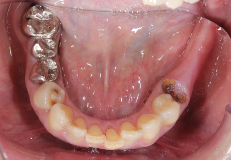 Dental implant for all molars before
