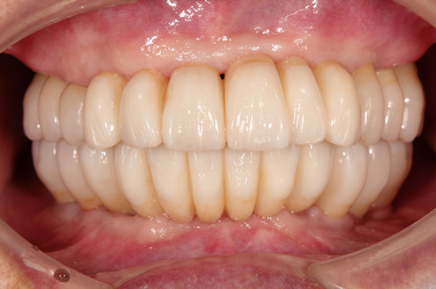 Dental implants for all teeth after
