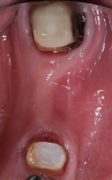 Dental implant for single molar tooth before