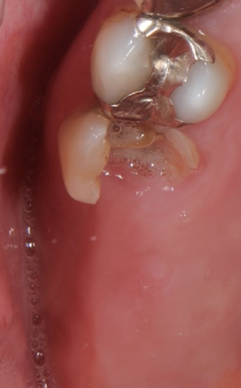 Dental implant for upper rear molars before
