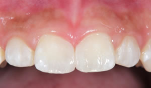 gap teeth after case 1