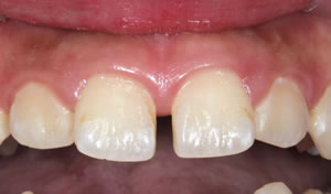 gap teeth before case 1
