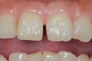 Gap teeth direct bonding example 1 before