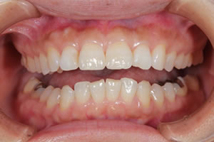 Gap teeth direct bonding example 1a after
