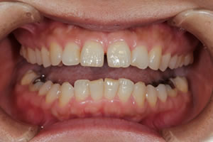 Gap teeth direct bonding example 1a before