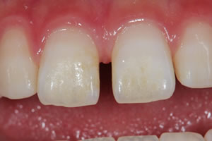 Gap teeth direct bonding example 2 before