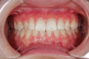 Gap teeth direct bonding example 2a after