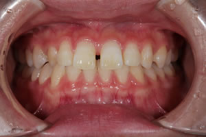 Gap teeth direct bonding example 2a before
