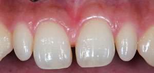 Gap teeth direct bonding example 3 before