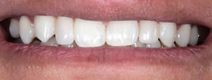 Gap teeth direct bonding example 3a after