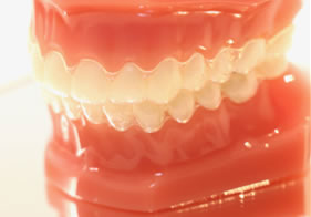 Invisalign and mouthpiece orthodontic treament
