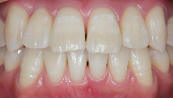 Teeth whitening after comparison photo