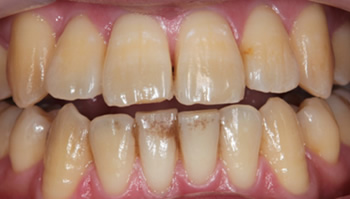 Teeth whitening before comparison photo