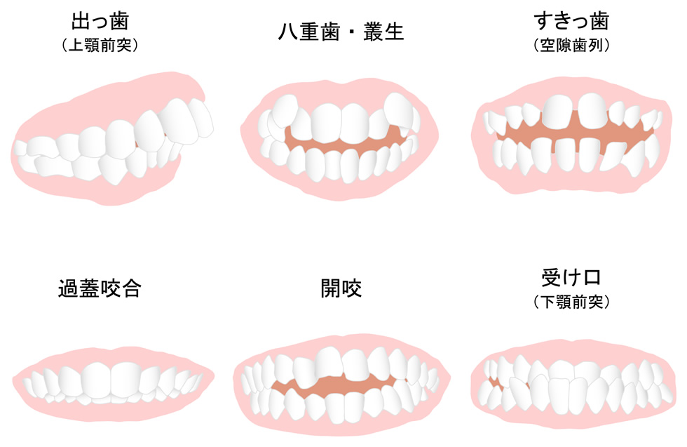 歯並び悪い。その原因と治療方法を徹底解説！あなたの悩みがこれで解決します。大阪で歯並びを治すならスマイルデザインクリニックへ