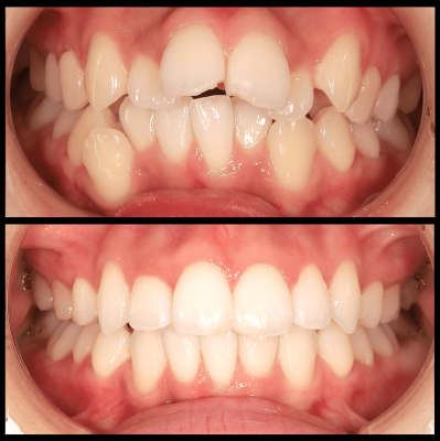 ガチャ歯の症例