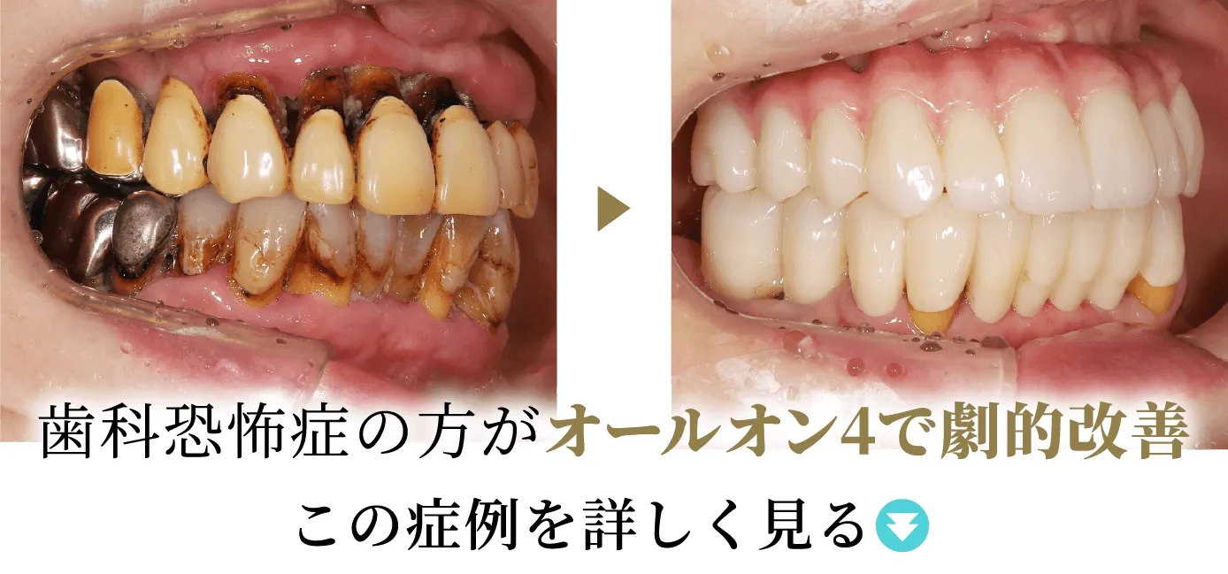 歯科恐怖症の方がオールオン4で劇的改善 この症例を詳しく見る