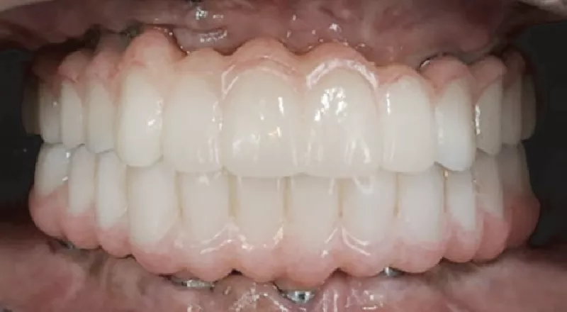 こちらの方実は24本全ての歯が人工の歯なのです。