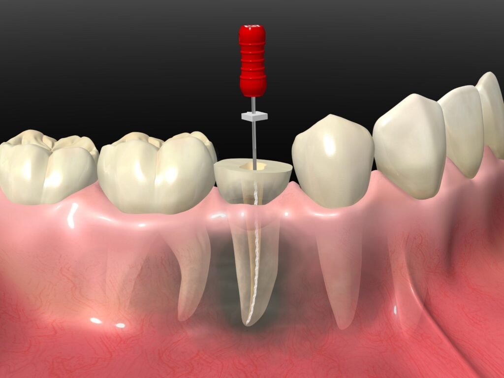 虫歯治療は基本的には根管治療！自分の歯を残す方向で考えよう