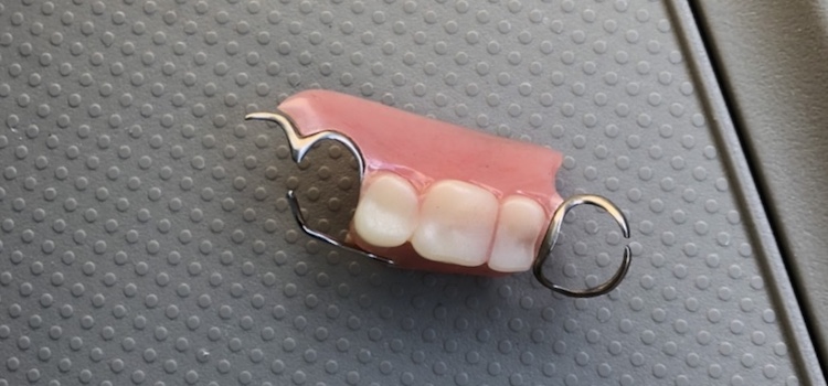 特徴③：部分入れ歯やブリッジの支えになっている歯