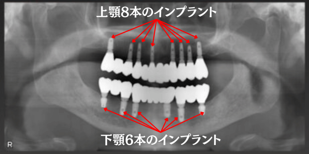 上顎8本と下顎6本のインプラントで、上下それぞれ12本ずつの人工歯を支えられるように設計しました。