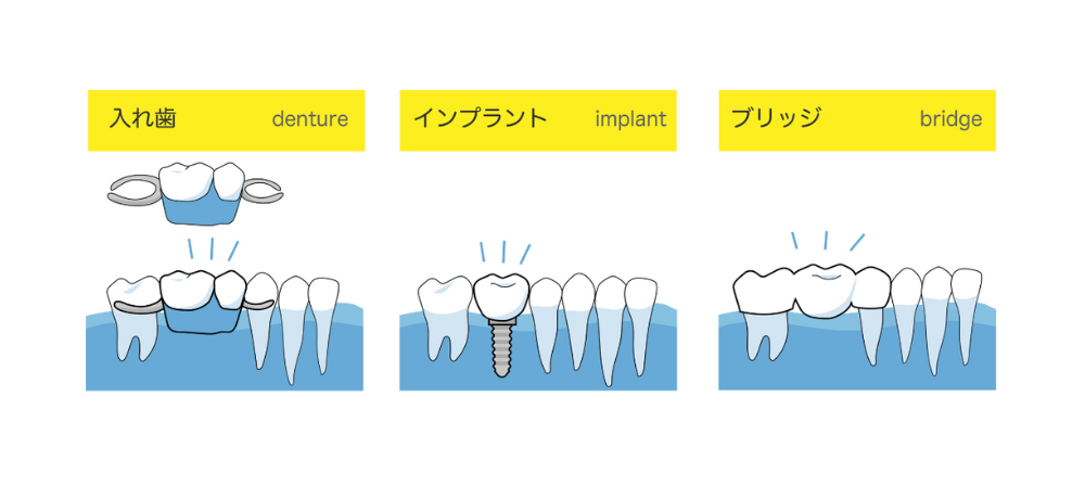 インプラントは前歯治療に向いている？ブリッジや入れ歯と徹底比較！