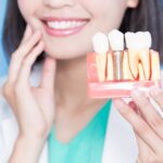 インプラントの種類とは？構造・素材・メーカー別にわかりやすく解説