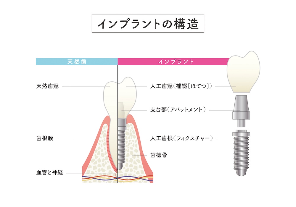 インプラントの被せ物（上部構造）とは？