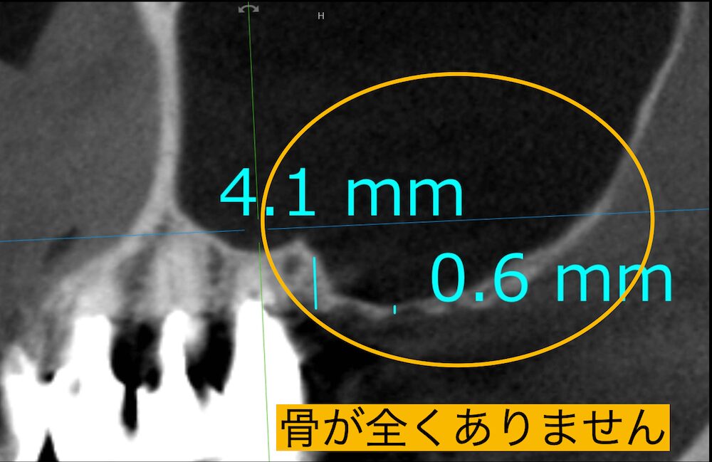 骨が全くありません